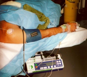 Machine for target controlled infusion for anaesthesia at patient bedside during war 1999