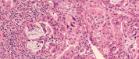Image of a pancreatic cancer histology section