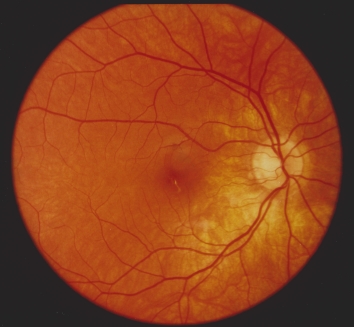 A retina scan showing Disciform maculopathy by Fraser Speirs