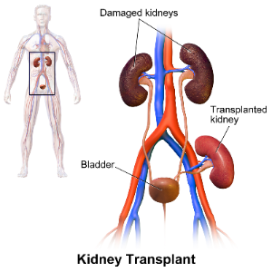 Abstract image of living-donor kidney exchange