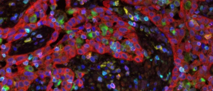 Image of tumour immune microenvironment, produced by multiplex immuno-fluorescence technology