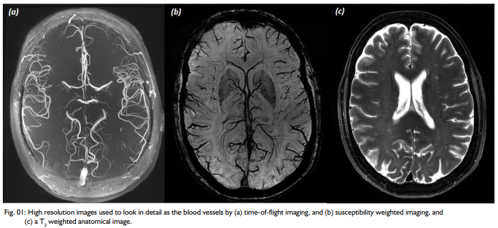 Time-of-flight, susceptibility weighted imaging, and T2 TSE 7T images