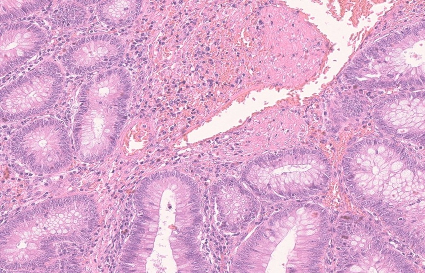 H&E stain of colonic polyp