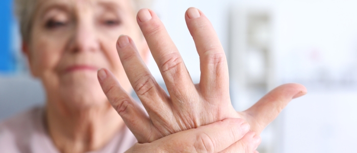 Image of a female displaying a hand with arthritis