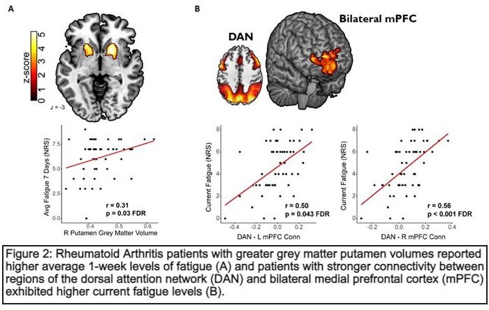 Figure 2. Rheumatoid Arthritis patients with greater grey matter putamen volumes reported higher average 1-week levels of fatigue (A) and patients with stronger connectivity between regions of the dorsal attention network (DAN) and bilateral medial prefrontal cortex (mPFC) exhibited higher current fatigue levels (B).