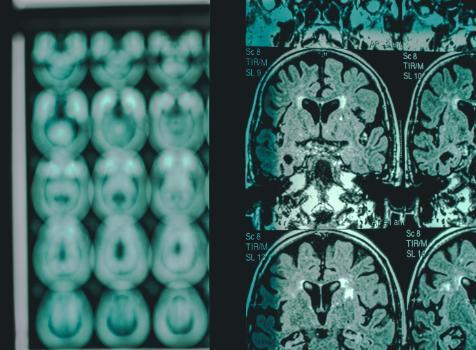 MRI Scan brain image showing evidence of Alzheimer's Disease