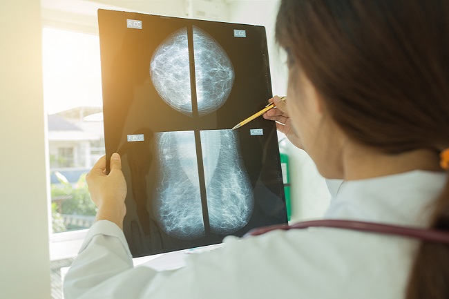 Doctor holding a breast cancer scan