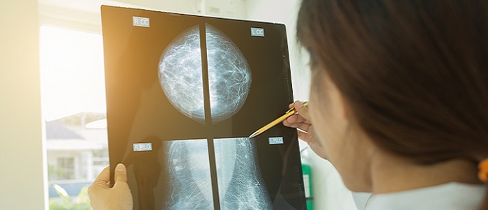 Doctor holding a breast cancer scan