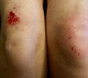 Photo of skint knees
