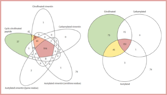 The types and combinations of different antibodies in the blood of rheumatoid arthritis sufferers can significantly alter the likelihood of joint damage and progression in the first year of disease