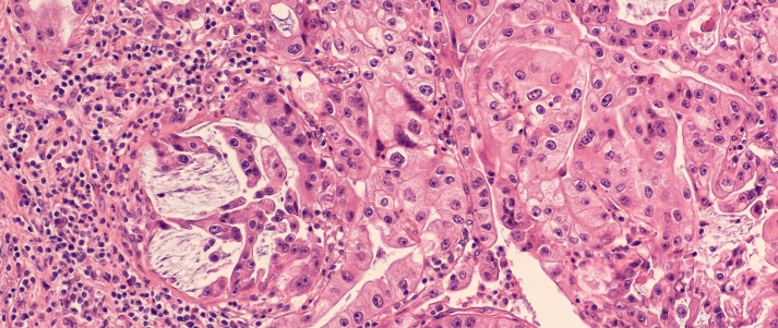 Pancreatic cancer histology section