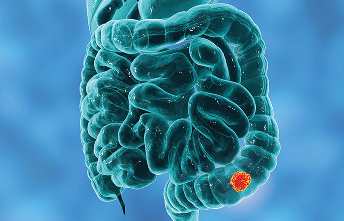 3D illustration showing cancerous tumor inside large intestine