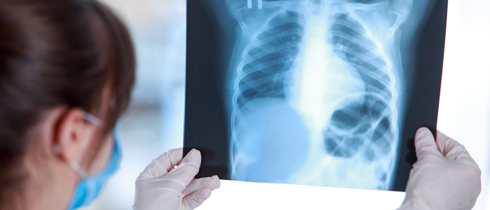 Photo of doctor holding chest xray 