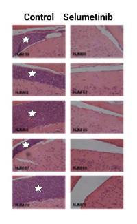 CNS leukaemia is significantly reduced by treatment with the MEK-inhibitor Selumetinib.