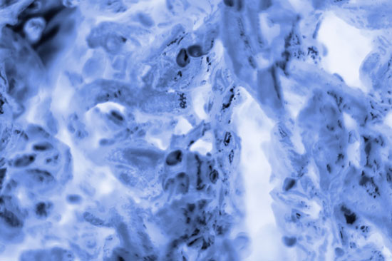 Prostate cancer cells stained with blue coomassie