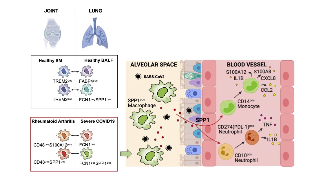 A graphical abstract showing how the SPP1 Myeloid pathway could be responsible for post-Covid syndrome