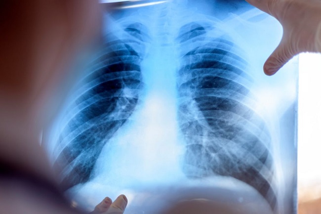 Image of a doctor holding up a lung scan