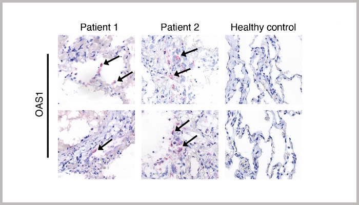 Detection of OAS1 gene expression by RNAscope in FFPE lung tissue of deceased COVID-19 patients compared to healthy control lung tissue of deceased COVID-19 patients compared to healthy control lung tissue. Arrows indicate staining +ve cells.