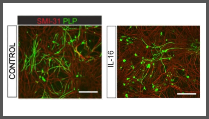 IL-16 expression is upregulated during in vitro demyelination and inhibits OPC differentiation and myelination.