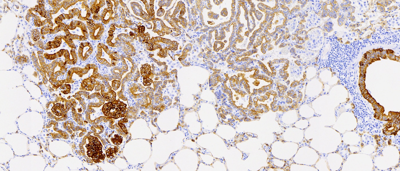 Ovine pulmonary adenocarcinoma (OPA) in a sheep anti-cytokeratin immunohistochemistry (IHC)