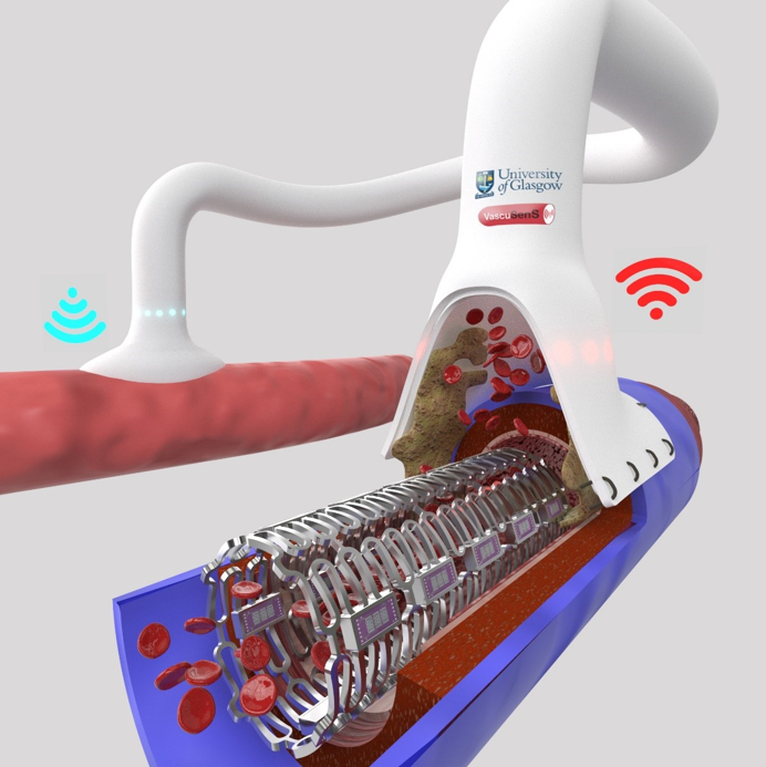 Image depicting the VascuSens technology; the non-invasive diagnostic can be integrated into implants and wirelessly report impending vascular complications in real-time.