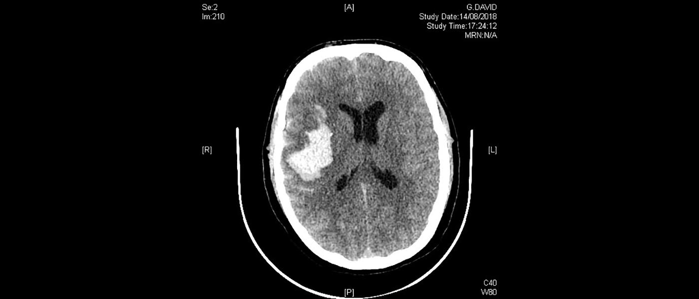 David's initial brain scan, showing the aneurysm