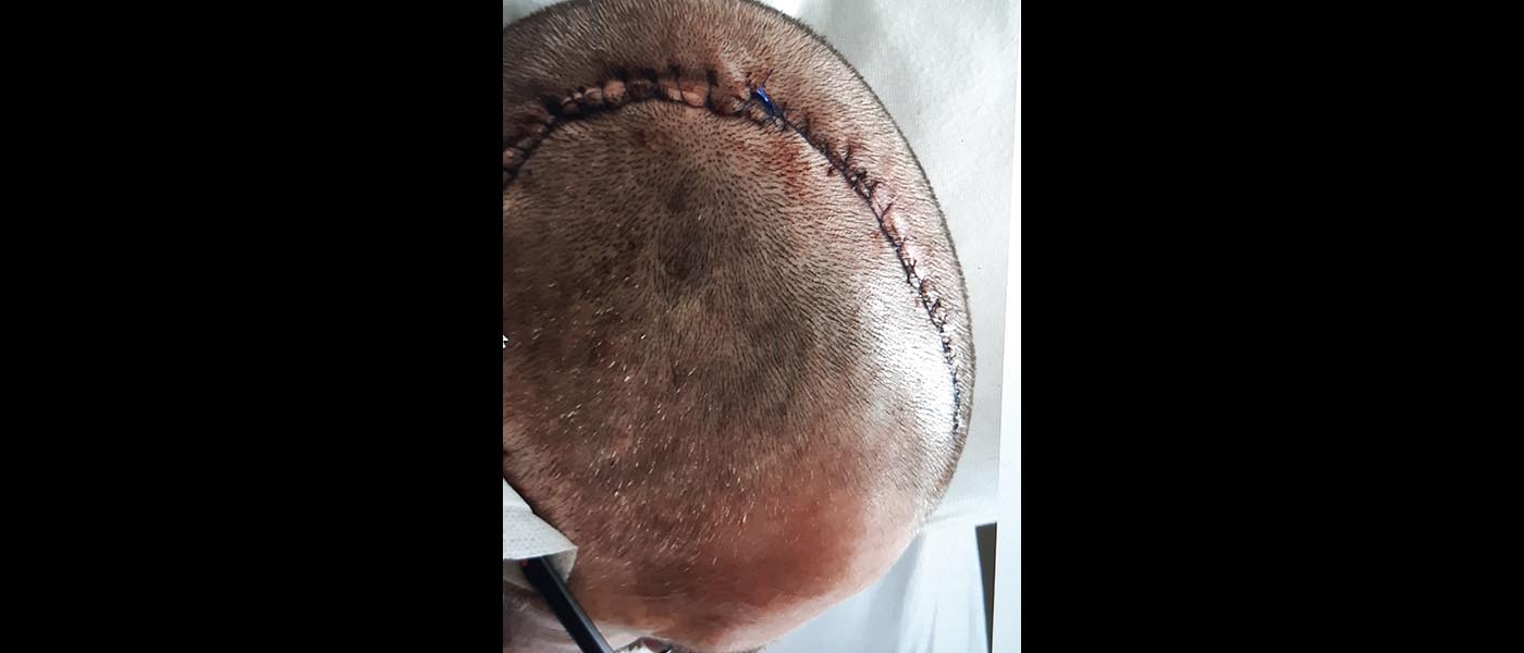 David's post-op scar