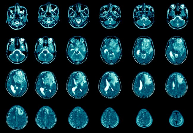Medical scans of a patient's brain with brain cancer
