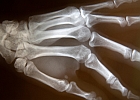 x-ray of hand