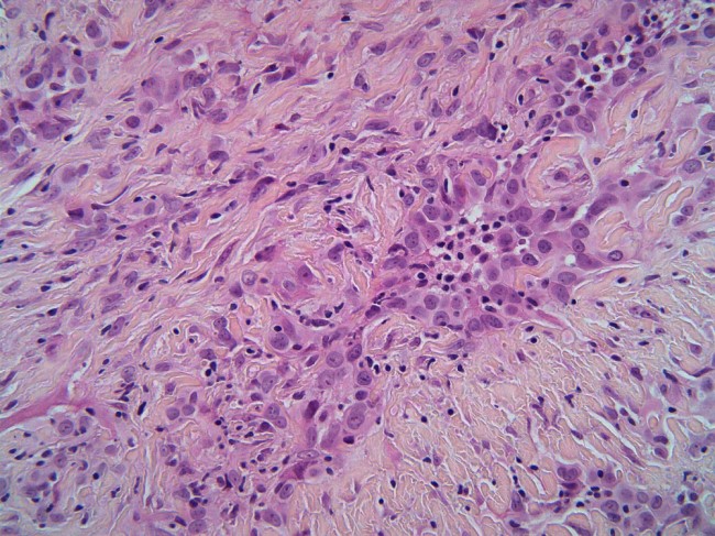 Image of mesothelioma cancer cells