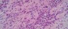 Image of mesothelioma cancer cells