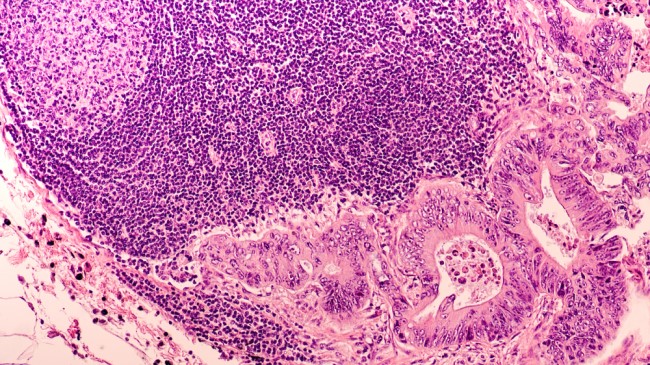 Colon/Bowel cancer cells image