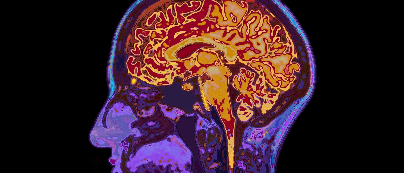 Photo of a brain scan in purple and orange with a black background