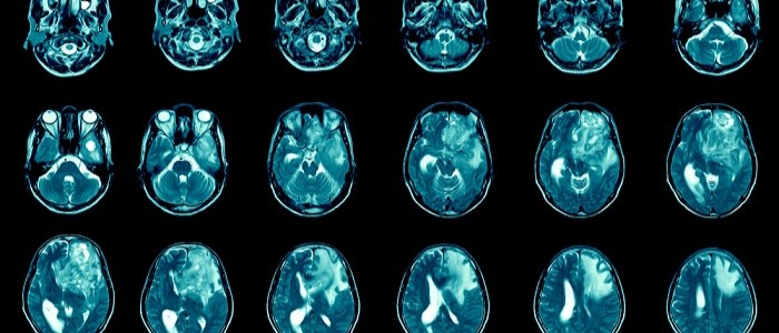 Scans of a patient with brain cancer